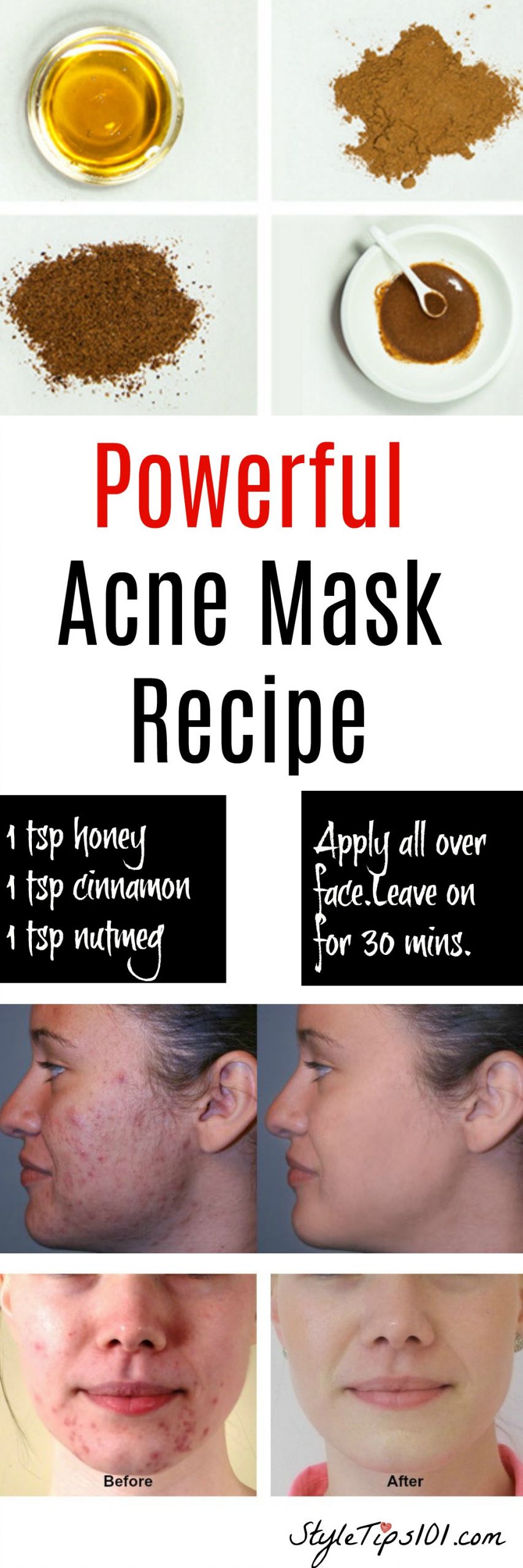 Acne DIY Face Mask
 Homemade Natural Acne Mask