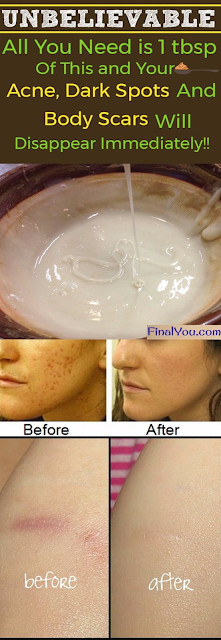 Acne DIY Mask
 UNBELIEVABLE HOMEMADE FACE MASK TO GET RID OF SPOTS