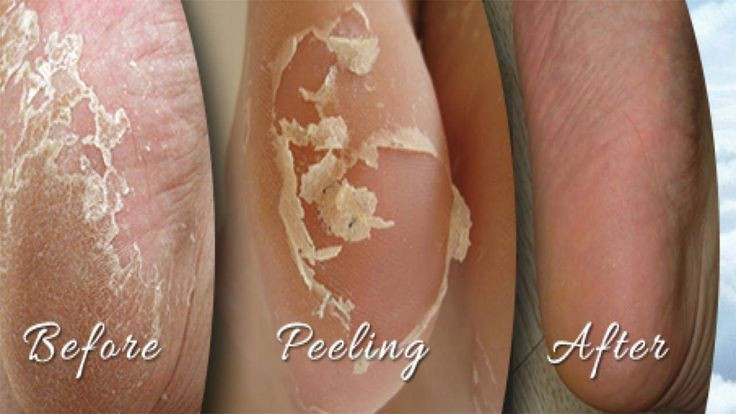 DIY Baby Feet Peel
 Home Reme s For Peeling Skin Your Feet TOP 5 DIY