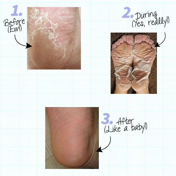 DIY Baby Feet Peel
 DS exclusive DIY natural skincare kits