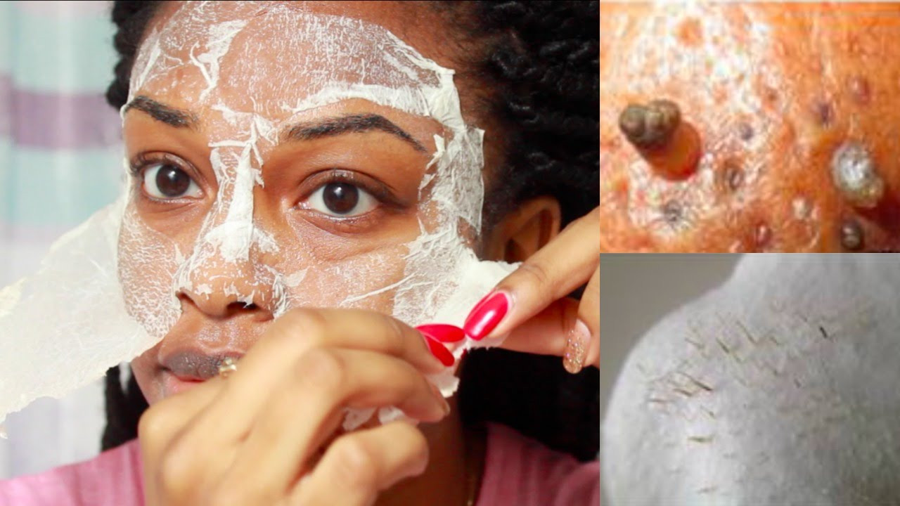 DIY Blackhead Remover Mask
 EASY DIY Egg Blackhead Remover Peel f Mask