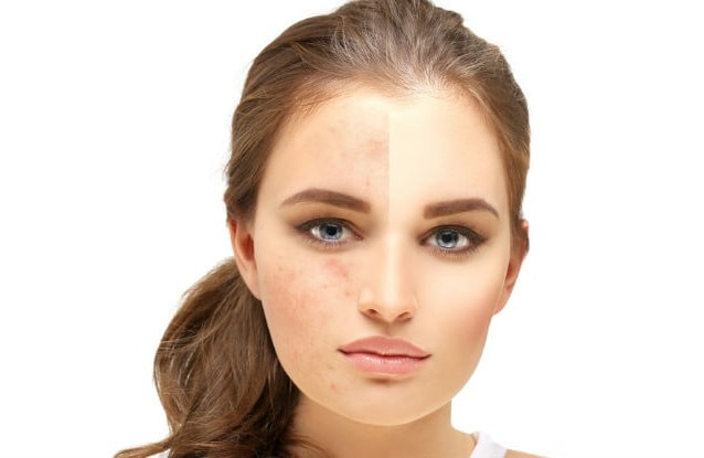 DIY Face Mask For Acne Scars
 8 Effective Natural DIY Homemade Face Masks for Acne Scars