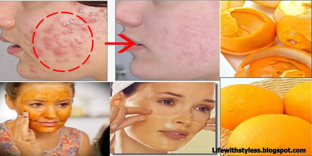 DIY Face Mask For Acne Scars
 Homemade Orange Peel Face Mask For Pimples And Acne Scars