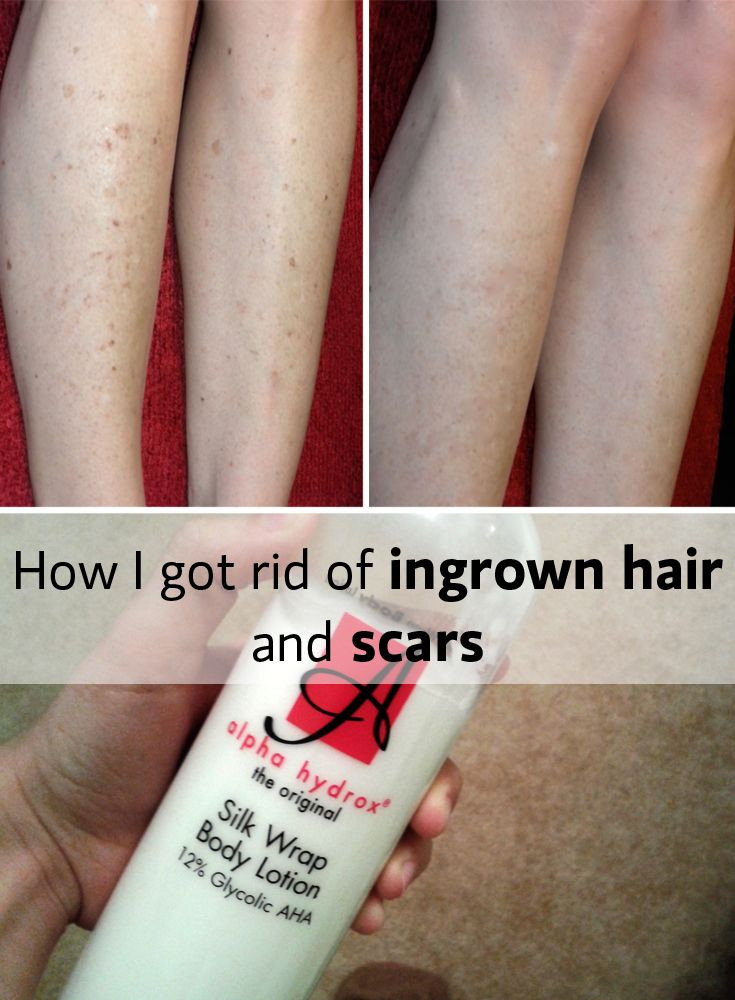 DIY Leg Hair Removal
 Ingrown hair is a problem most of us girls have at east