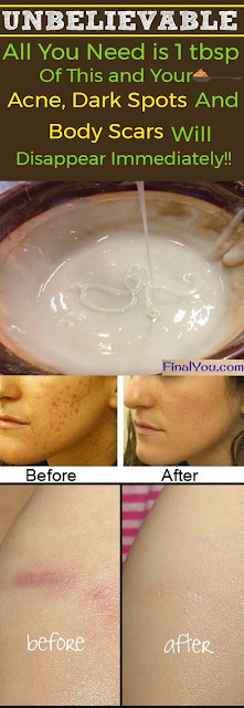 DIY Masks For Acne Scars
 UNBELIEVABLE HOMEMADE FACE MASK TO GET RID OF SPOTS