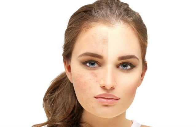 DIY Masks For Acne Scars
 8 Effective Natural DIY Homemade Face Masks for Acne Scars