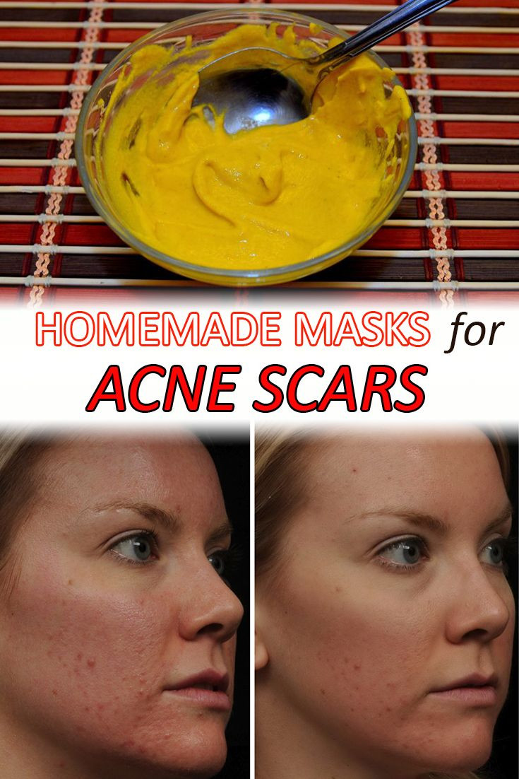 DIY Masks For Acne Scars
 407 best DIY Beauty Tips and Tricks images on Pinterest