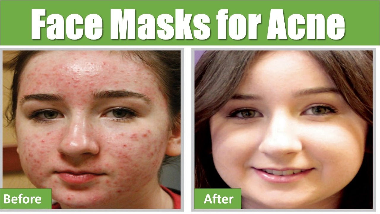 Easy DIY Face Mask For Acne
 Easy DIY Homemade Natural Face Masks for Acne