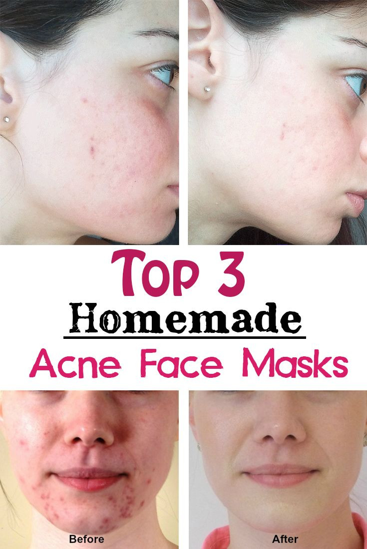 Face Mask For Acne DIY
 Top 3 Homemade Acne Face Masks
