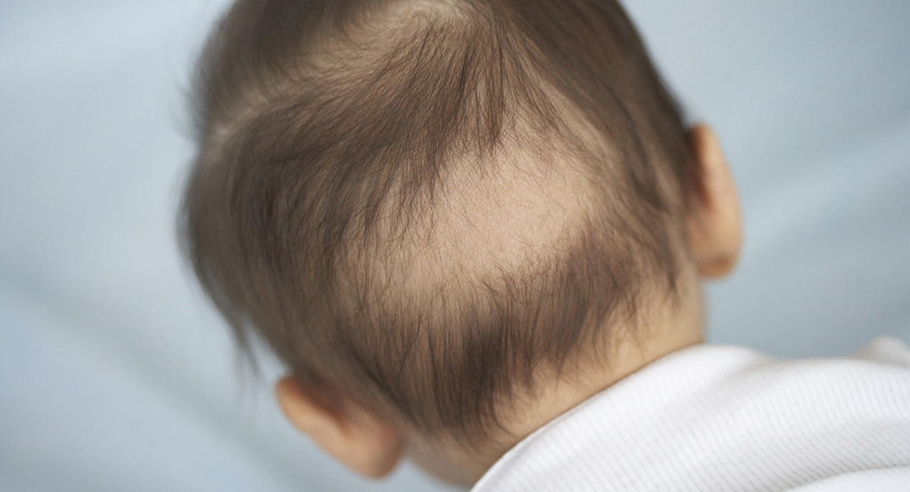 My Baby Is Losing Hair
 Hair loss in babies