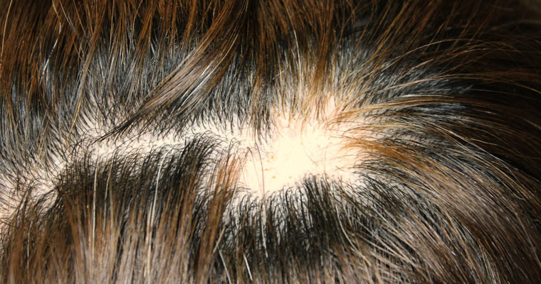 Thinning Hair In Children Symptom Checker
 Bald patch on back of head female