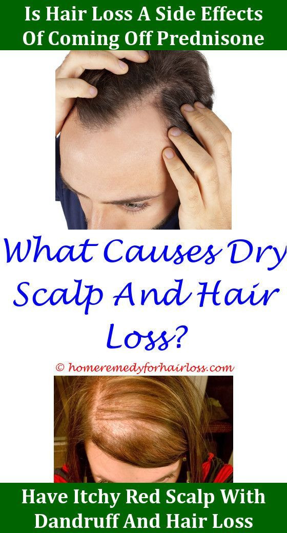 Thinning Hair In Children Symptom Checker
 Cb Hair Loss seborrheic dermatitis scalp hair loss Hair