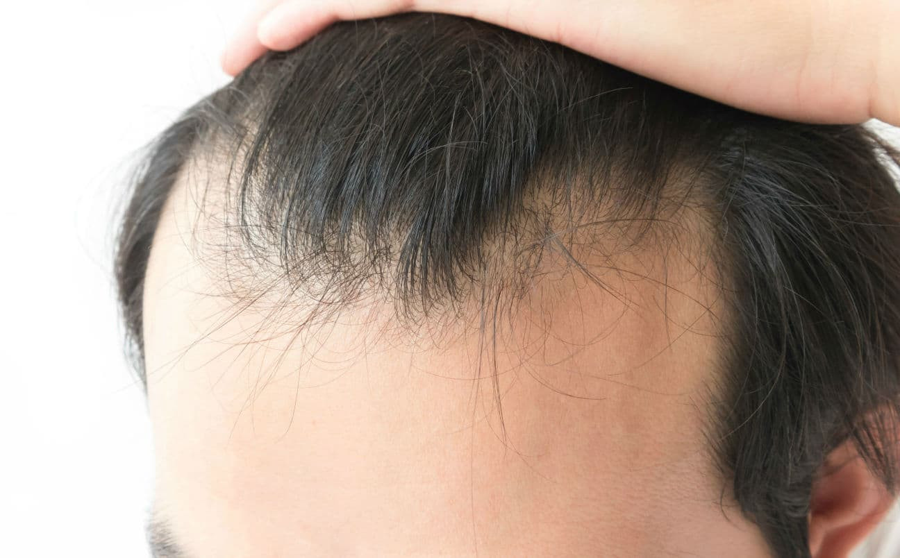 Thinning Hair In Children Symptom Checker
 Causes of Hair Loss in Men Reasons For Thinning Hair