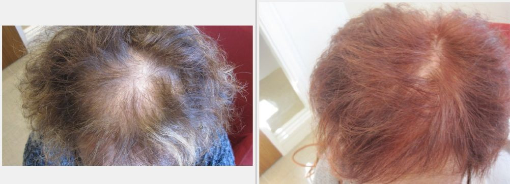 Thinning Hair In Children Symptom Checker
 Receding Hairline Color Hair Loss Restoration Reviews