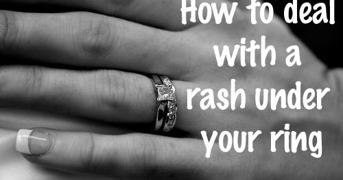 Wedding Ring Rash
 Dr Visha Blog The Rash Under The Ring