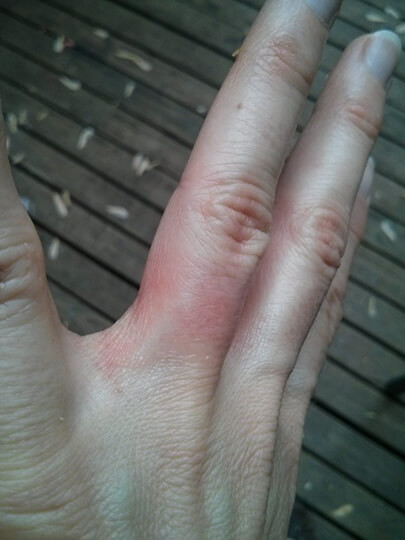 Wedding Ring Rash
 How Your Allergy to Nickel May Be Causing Wedding Ring