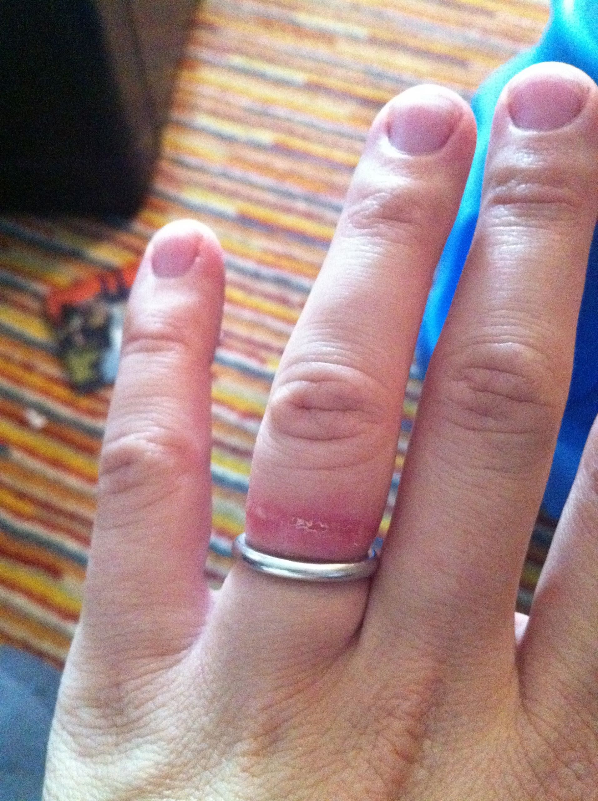 Wedding Ring Rash
 Itchy Rash Ring Finger