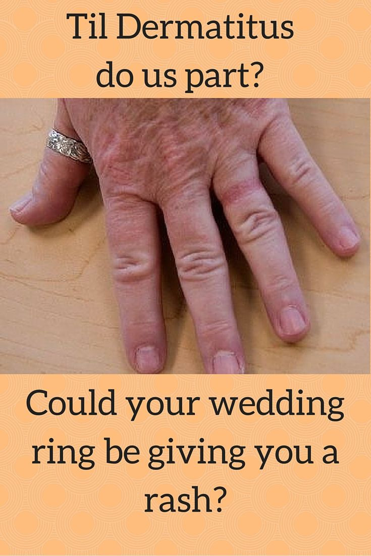 Wedding Ring Rash
 Wedding Ring Dermatitis Article by Wall Street Journal