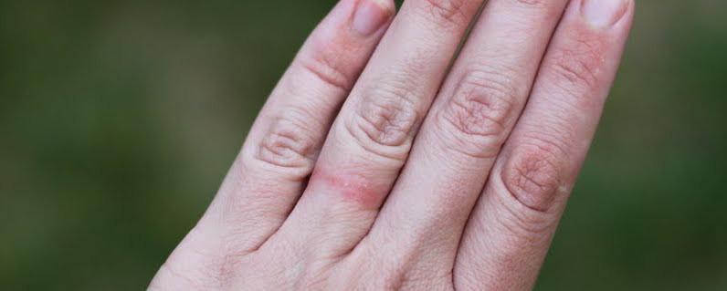 Wedding Ring Rash
 Are You Allergic To Your Wedding Ring