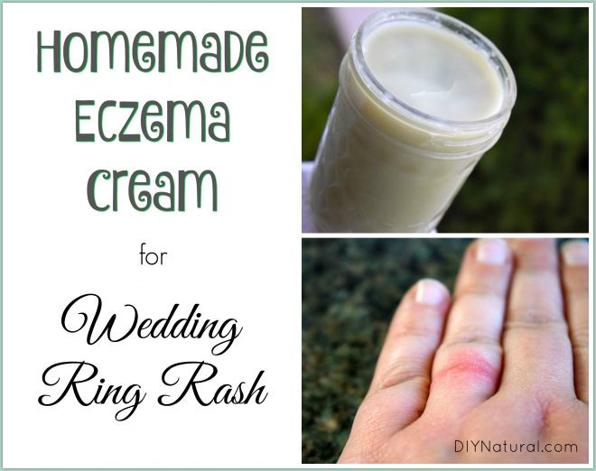 Wedding Ring Rash
 Homemade Eczema Cream Relief for Wedding Ring Rash and More